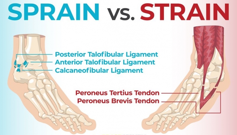 Difference Between A Strain Sprain Explained Physio Clinic Bristol difference-between-a-strain-sprain-explained-physio-clinic-bristol